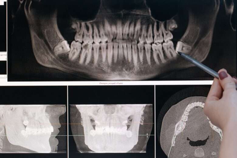 Misaligned_Teeth